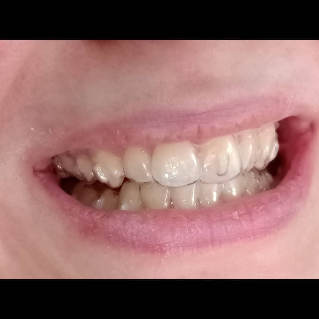 Sourire — patient